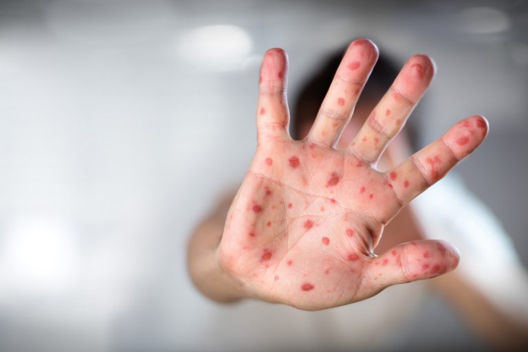 Pediatra alerta sobre os perigos do sarampo e a importância da vacinação